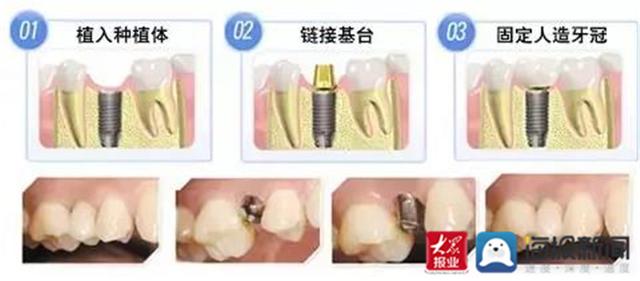 泰安市口腔医院：种植牙，缺失牙患者的选择