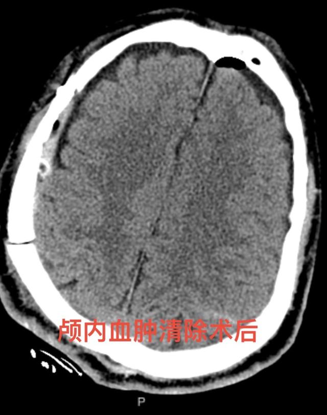 多学科协作接力完成六部位手术 淄博市中心医院助高处坠落患者转危为安