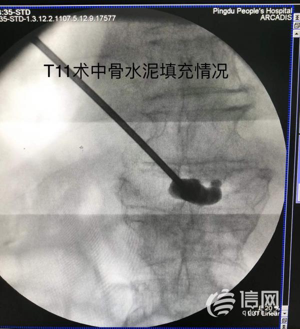 高龄患者遭遇车祸 平度市人民医院微创手术恢复健康