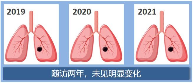 肺结节是不是肺癌？影像检查该做哪个？……一文全读懂！