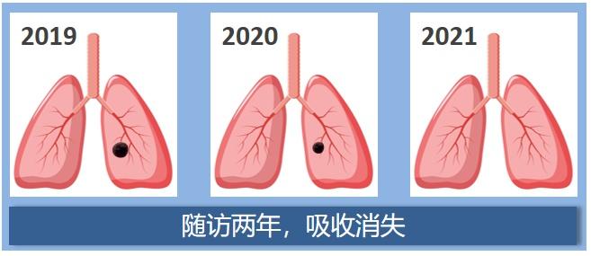 肺结节是不是肺癌？影像检查该做哪个？……一文全读懂！