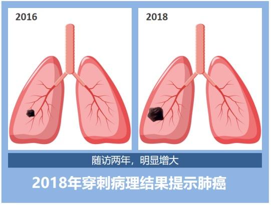 肺结节是不是肺癌？影像检查该做哪个？……一文全读懂！