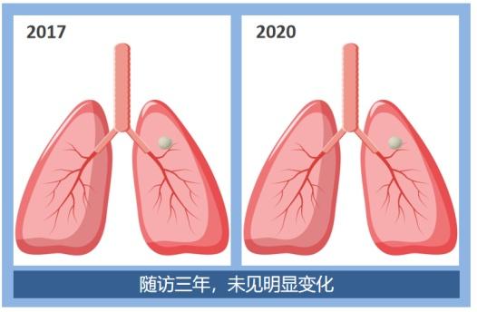 肺结节是不是肺癌？影像检查该做哪个？……一文全读懂！