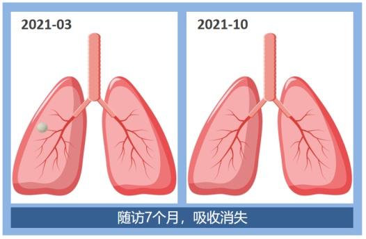 肺结节是不是肺癌？影像检查该做哪个？……一文全读懂！