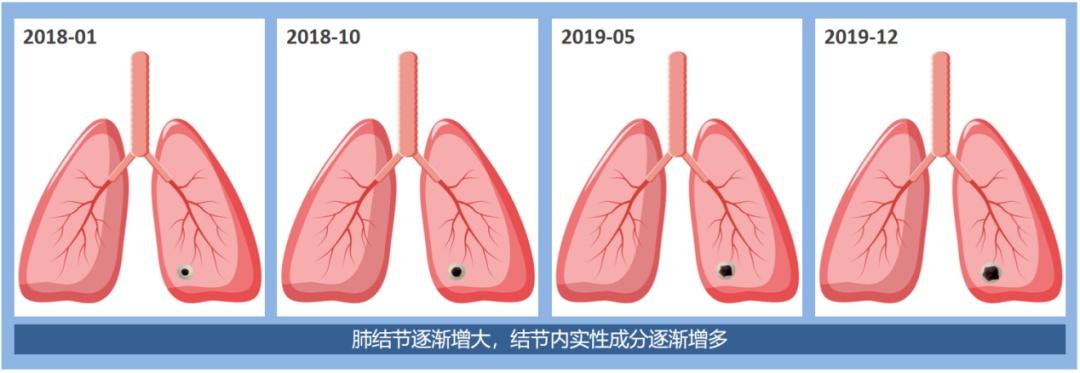 肺结节是不是肺癌？影像检查该做哪个？……一文全读懂！