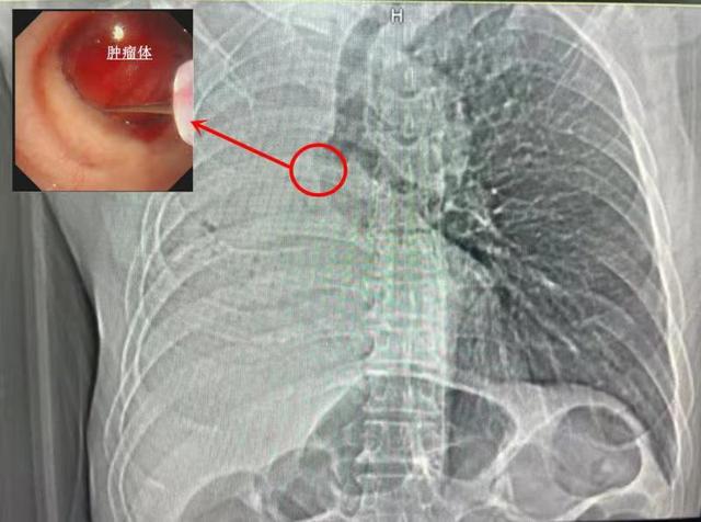 手指粗肉瘤突然疯长进男子支气管三四十年烟龄、酒龄成为肿瘤温床