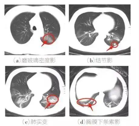 疫情通报怎么看？确诊病例、核酸检测呈阳性有何区别？