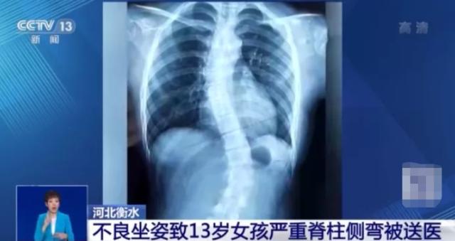 健康 | 中小学生脊柱侧弯人数已超500万！这些不良习惯速改……