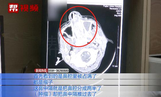 呼吸困难，流鼻血...男孩无法呼吸，竟被查出鼻腔内长肿瘤