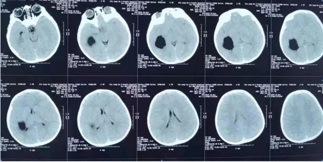 信阳市中心医院神经外科成功为一位患儿完成脑实质内囊肿内造瘘微创手术