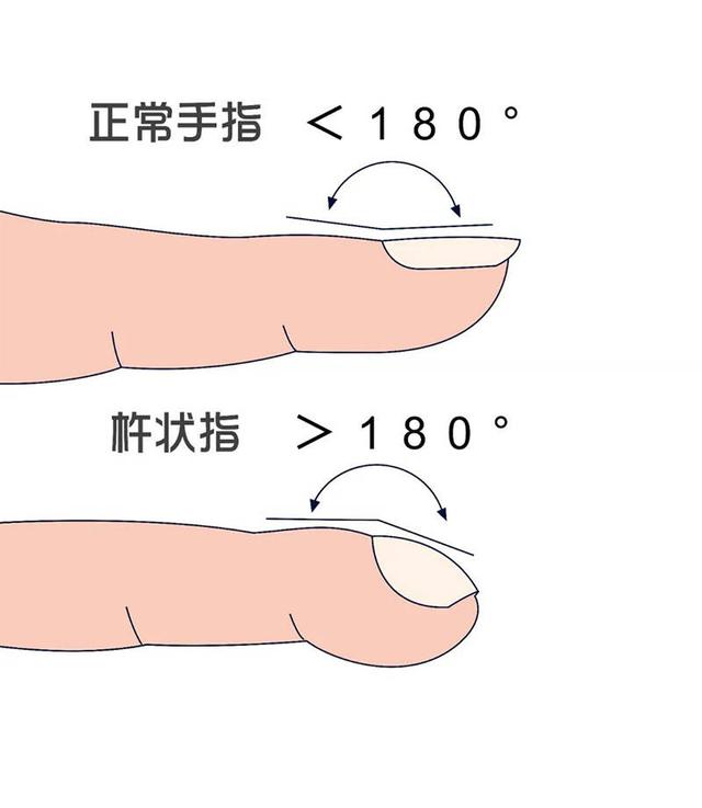 手指末端像棒槌？当心疾病找上门