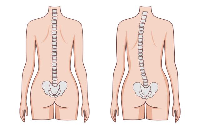 孩子坐姿总不对，当心是脊柱侧弯！家长一定要警惕！2个方法在家自测——