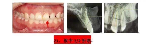 同仁医线丨精准种植，美学修复，再也不用愁眉苦脸了