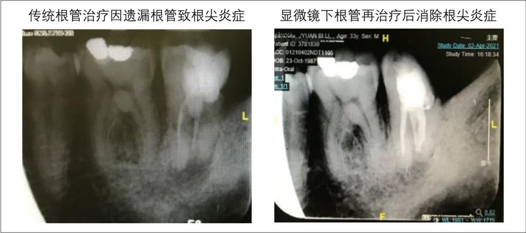 显微根管治疗：“无微不致”到牙齿深处