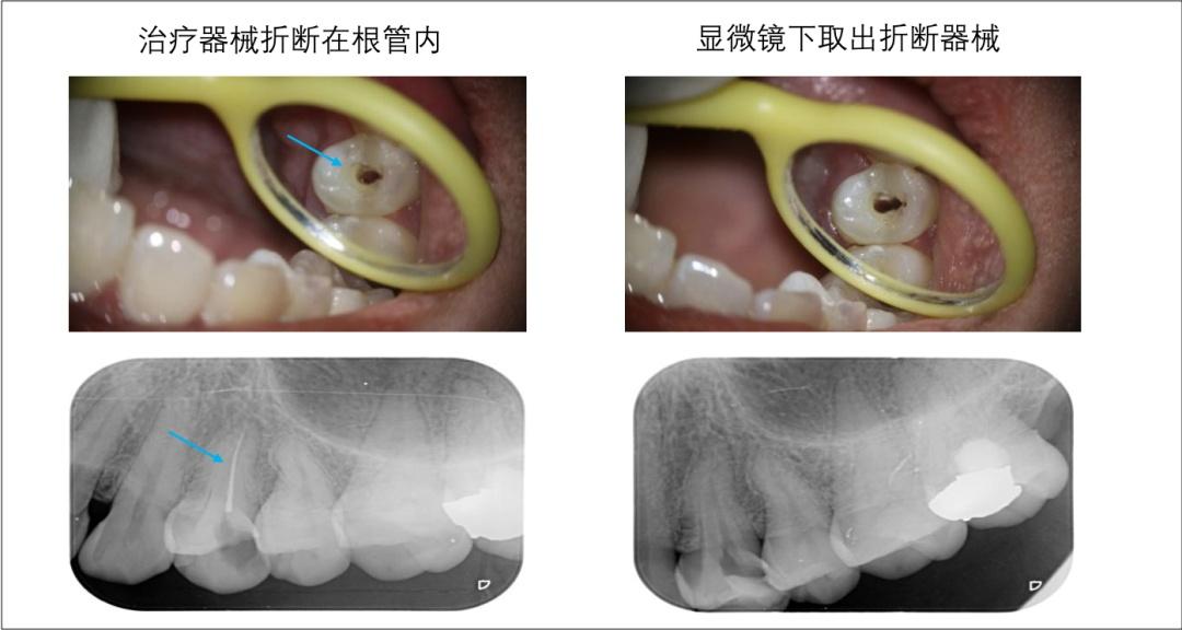 显微根管治疗：“无微不致”到牙齿深处