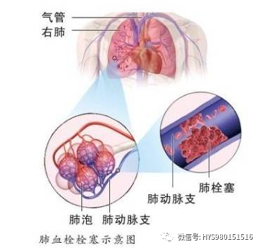 肺栓塞的观察与护理，做好这些护士才合格了！