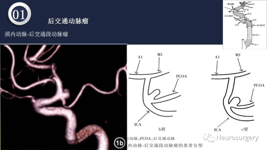 头颈动脉系统解剖