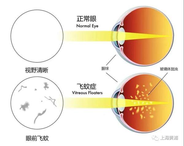 眼前有“虫影”飘来飘去，是要瞎的征兆吗？