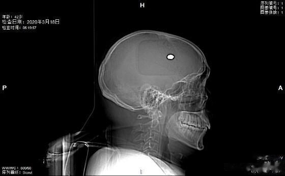 钢珠射穿男子左眼后进入颅内，左右游走后癫痫发作，两次手术后，医生为其取出钢珠