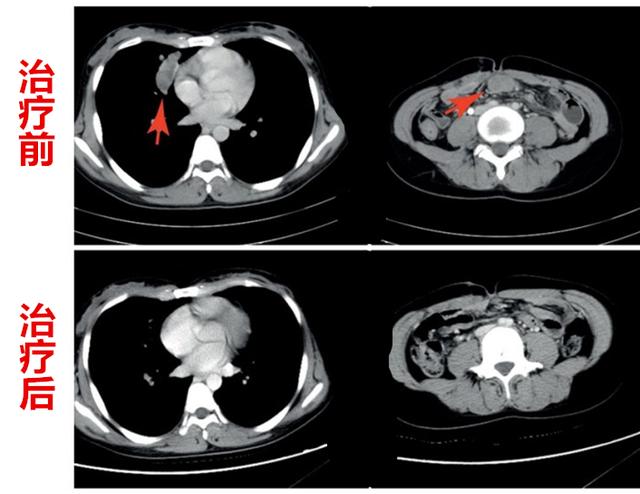 两位年轻宝妈不幸患癌，不同免疫疗法产生相同奇迹