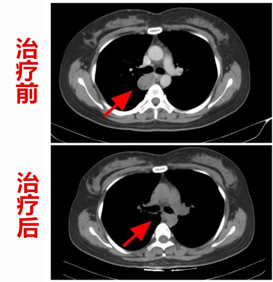 两位年轻宝妈不幸患癌，不同免疫疗法产生相同奇迹