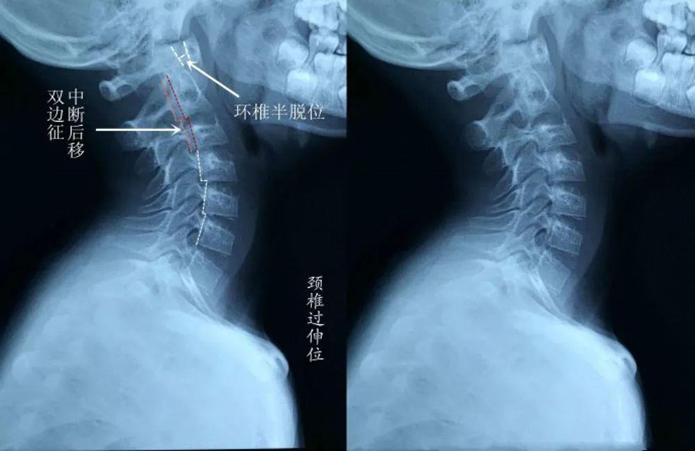 门诊来了个“落枕”的孩子，检查结果竟是颈椎脱位了？