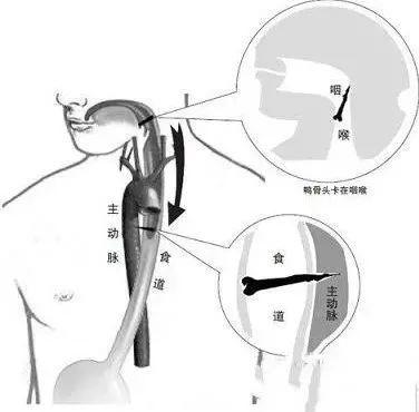 惊 | 一顿饭，让大叔咳嗽，胸痛两年，检查发现左侧气管内还有个闪闪发光的东西...