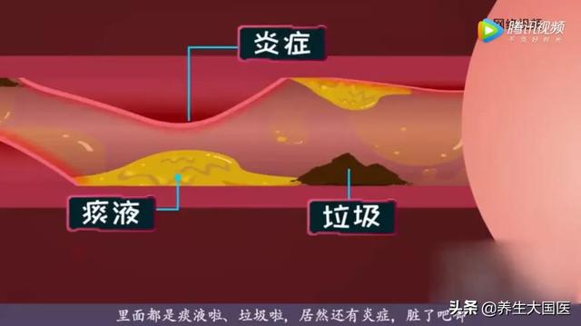 冬天老咳嗽？中医“两字”原则助你清顽痰、扶正气，气管通畅呼吸轻松