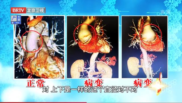 9年经历8次手术，到底是什么心脏病，这么难缠？