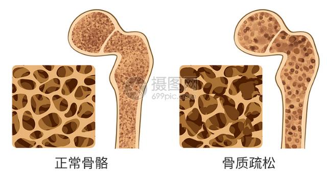 风湿亭 | 防治骨质疏松，为何补钙的同时补充维生素D？