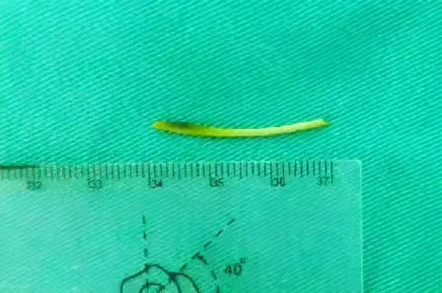 3厘米长的鱼刺，扎破肠管进入腹腔，最后刺入胃部