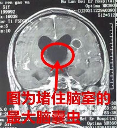 女子时常头痛、呕吐 医生在她脑中取出一条条小“鱼”！医生：发病时间可能超过40年！