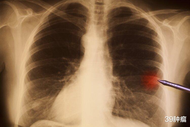 体检查出肺结节怎么办？若有4个特征，恶性程度高，建议及时切除