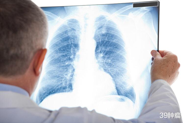 体检查出肺结节怎么办？若有4个特征，恶性程度高，建议及时切除