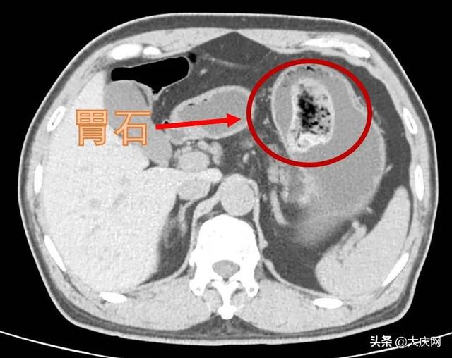 男子胃里长出一块大“石头”，只因平常爱吃这个东西