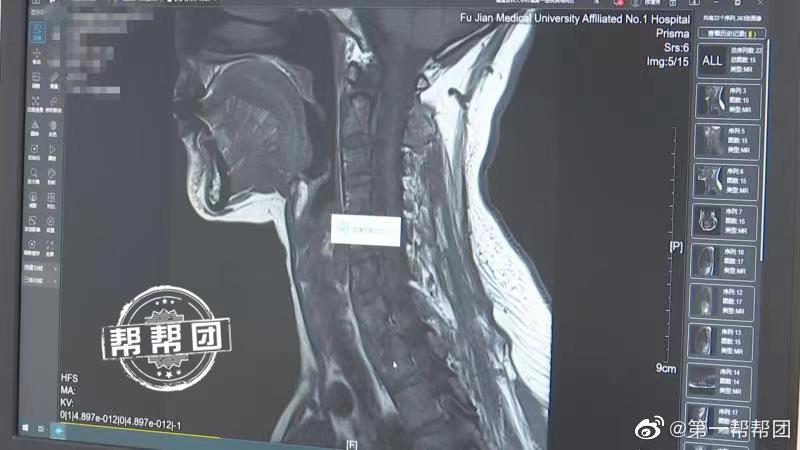 关节莫名疼痛后男子竟被查出感染病菌？医生：吃生食的恶果