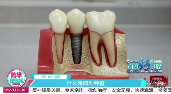 你知道什么是“即刻种植”吗？所有人都可以做吗？答案都在这里