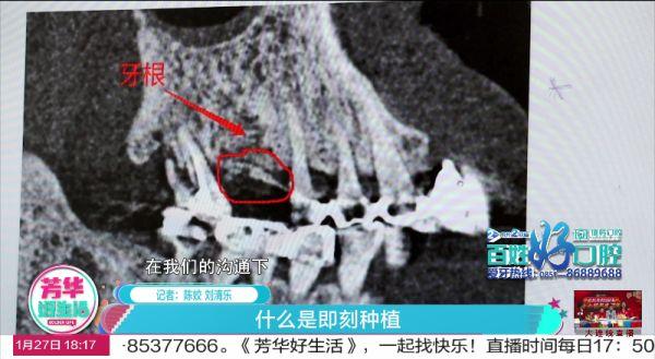 你知道什么是“即刻种植”吗？所有人都可以做吗？答案都在这里