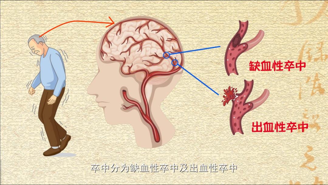 科普｜八桂中医大讲堂（20）：发生中风怎么办？