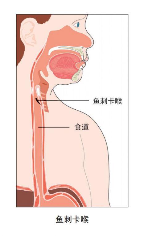 鱼刺卡喉喝醋？吞馒头？这些错误的方法要避开！