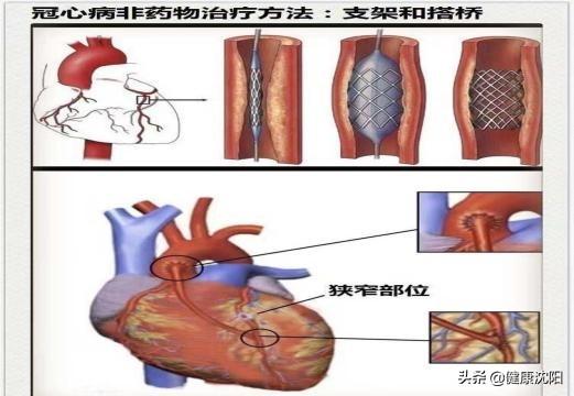 把健康带回家 | 春节期间如何防治冠心病