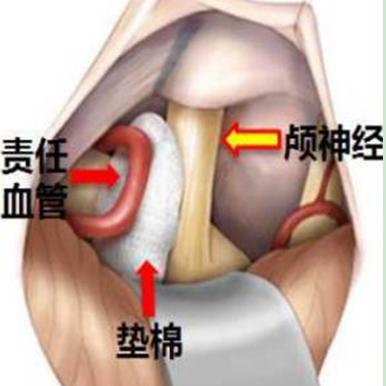 潍坊市人民医院专家提醒：不是所有的面部抽动都叫面肌痉挛