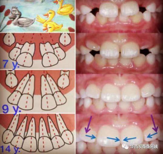 过年回家被人说孩子牙齿长丑了要箍？华西口腔专家教你辨别