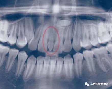 过年回家被人说孩子牙齿长丑了要箍？华西口腔专家教你辨别