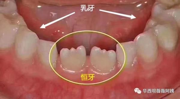 过年回家被人说孩子牙齿长丑了要箍？华西口腔专家教你辨别