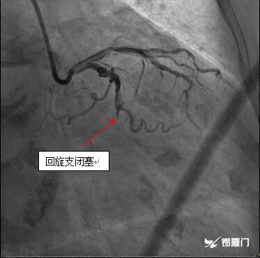 快速！他们为95岁急性心梗老人开通血管