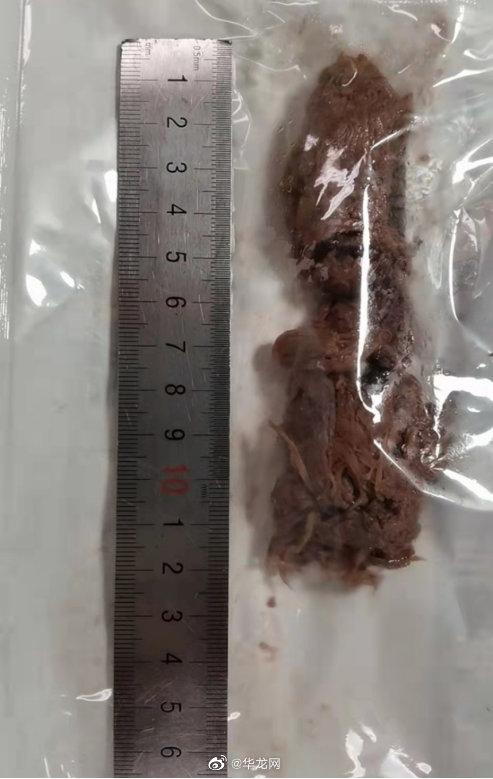 危急！男子吃大块牛肉致气道阻塞 缺氧超过1个小时