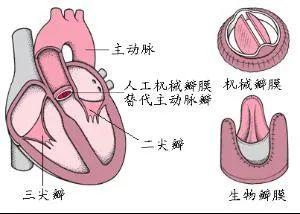 莫名头晕竟是心脏引起？68岁大伯这样保住自己的原装“零件”