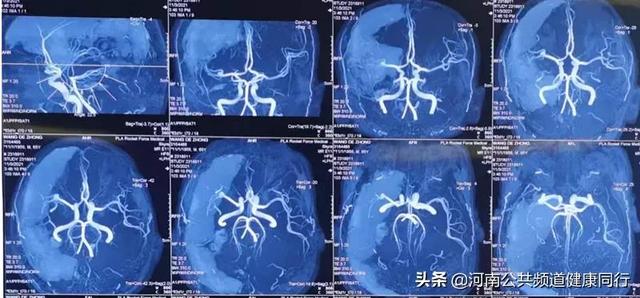 这是一颗“不定时炸弹”，它和明天不知道谁先到来——颅内动脉瘤破裂的一些事儿