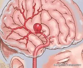 这是一颗“不定时炸弹”，它和明天不知道谁先到来——颅内动脉瘤破裂的一些事儿